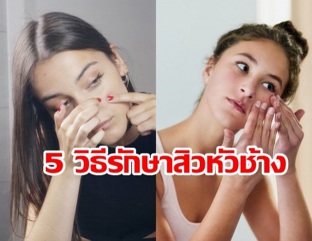 5 วิธีรักษาสิวหัวช้าง แบบเบื้องต้นด้วยตัวเอง นอกจากอย่าแกะ เกา ควรทำตามนี้