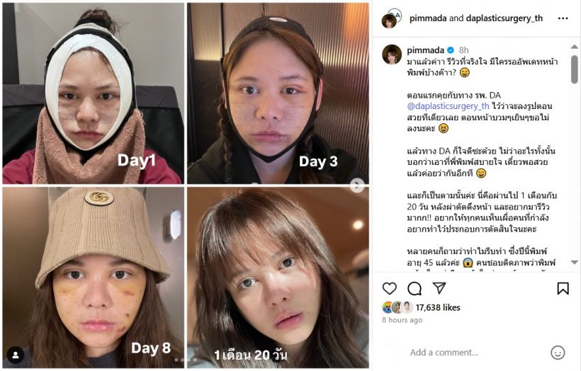 เปิดภาพ Before & After! พิมพ์ พิมพ์มาดา วัย 45 สวยสับหน้าเด็กกระชากวัย